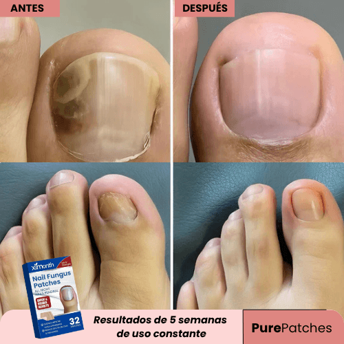 PARCHES ANTI-HONGOS PARA UÑAS