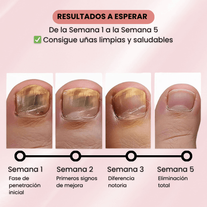 PARCHES ANTI-HONGOS PARA UÑAS
